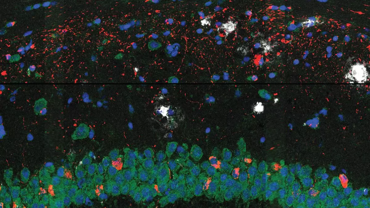 SCIENCE NOTEBOOK | Protein deposits cause neuron death in Alzheimer’s