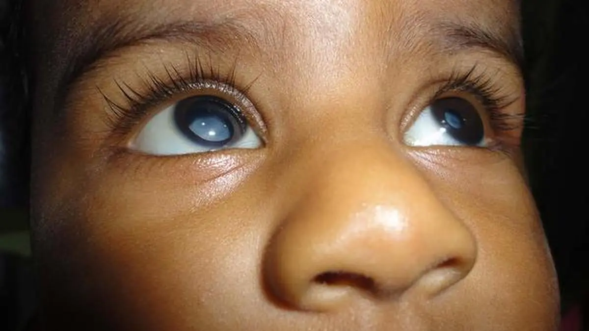 Cataract and babies Frontline